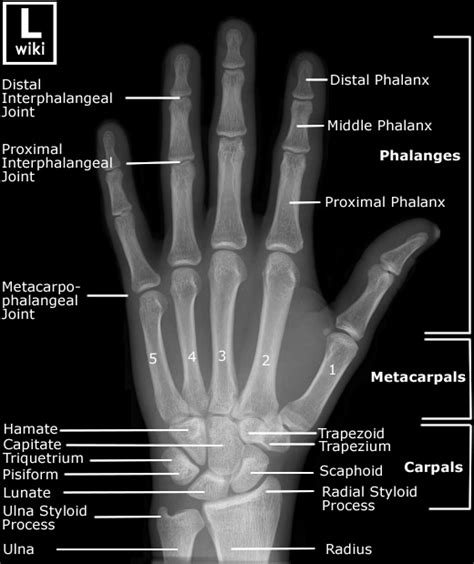 Hand Injuries Emcage