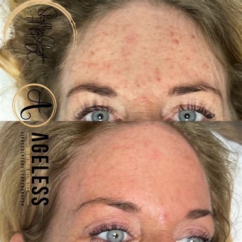 Laser Treatments Indianapolis In Ageless Aesthetics