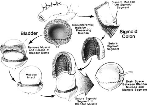 Overactive Bladder Oab Department Of Obstetrics And Gynecology Faculty Of Medicine Chiang