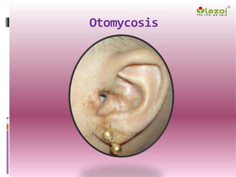 Otomycosis Causes And Symptoms Healthtian
