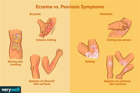 How Eczema And Psoriasis Are Different