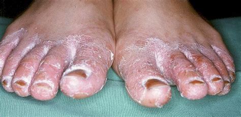 Tinea Pedis Athletes Foot