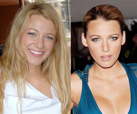 20 Most Influencing Best Plastic Surgery Before And After