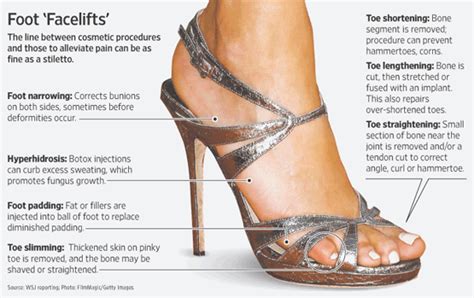 Toe The Line Doctors Fight Cosmetic Foot Surgery Wsj