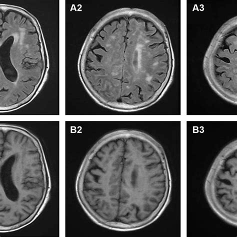 Pdf Cryptococcal Meningitis Mimicking Cerebral Infarction A Case Report