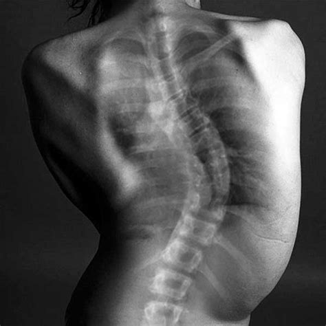 scoliosis education treatment options setting scoliosis straight