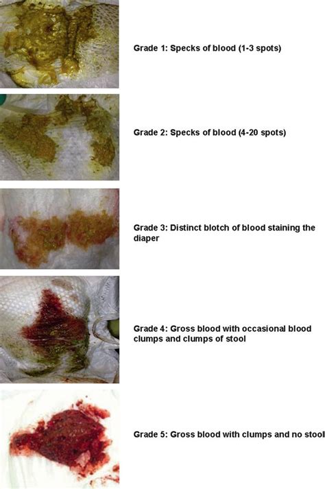 Assessment Of The Severity Of Visible Blood In The Stool Using A
