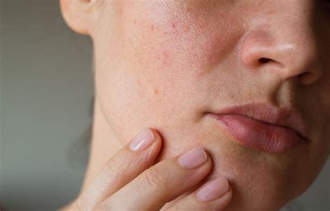 10 Symptoms Of Rosacea Facty Health