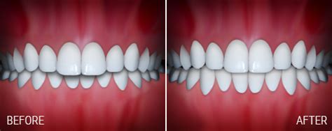 Before And After Daniel Meyers Orthodontics Santa Fe Nm