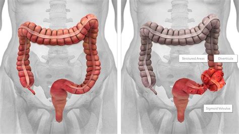 A Volvulus Is A Rare Condition That Occurs When Part Of The Colon