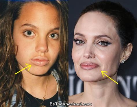 Angelina Jolie Plastic Surgery Comparison Photos Be The Knockout