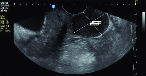 Transvaginal Ultrasound Imaging Sagittal View Of A Mass On The