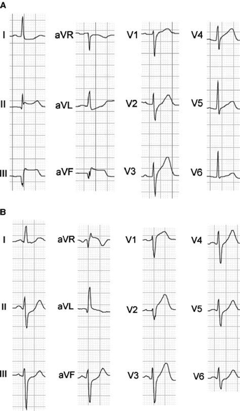 Twelve Lead Electrocardiographic Morphologies Demonstrating