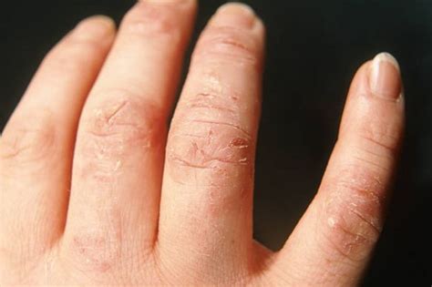 Hand Washing Advice To Ease Eczema And Dry Skin Amid Coronavirus