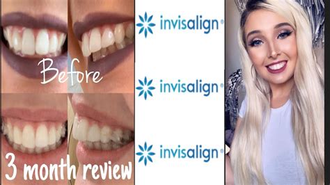 Invisalign Overbite Correction 3 Month Review With Before And After Pics Youtube