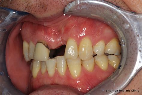 problems   front teeth dental implants