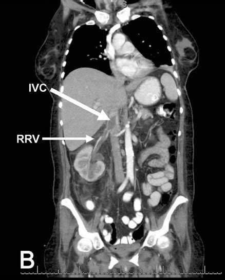 Coronal View Of Ct Scan Of The Abdomen And Pelvis Withi Open I