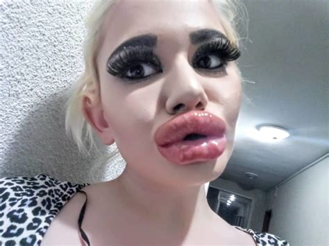 a bulgarian girl had 17 lip augmentation surgeries and wants more demotix