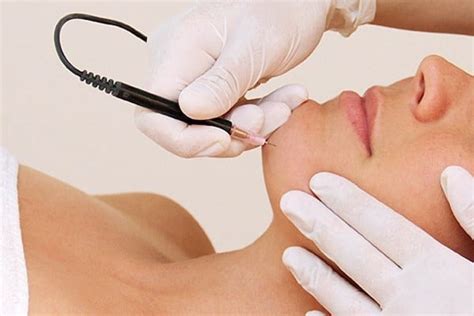 Considering Electrolysis How Many Sessions Does It Take Alite Laser Hair Removal