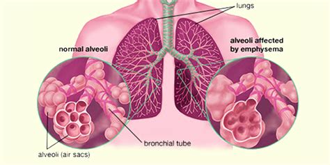 What Is Emphysema Causes Symptoms And Treatment