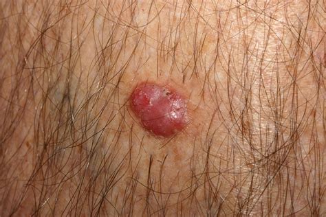 Basal Cell Carcinoma Symptoms Types And Pictures Vrogue