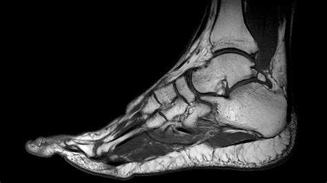 Foot Muscles Mri Accessory Muscles Of The Ankle Radsource The