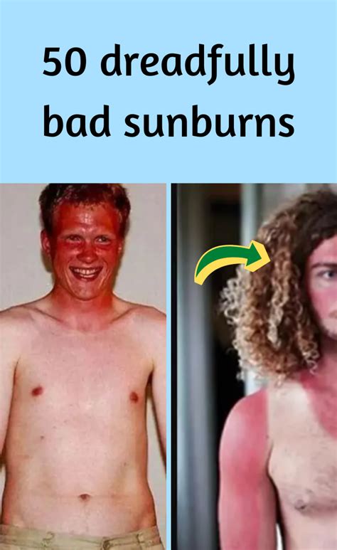 Dreadfully Bad Sunburns Where People Didnt Stand A Chance Against The Sun Bad Sunburn