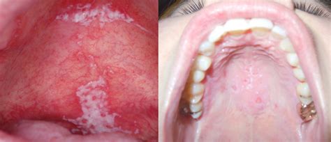 What Is Roof Of The Mouth Sore Know Its Causes And Remedies