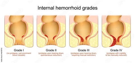 Hemorrhoid Grades Stage Of Internal Piles Stock Vector Adobe Stock