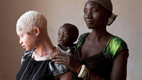 Hope For Nigeria Tanzania Prohibits Witch Doctors To Curb Albino