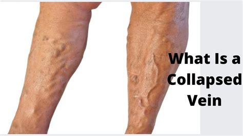What Is A Collapsed Vein Youtube