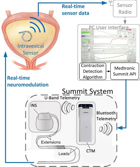 Ics Abstract Neuromodulation For Overactive Bladder Syndrome Sexiz Pix