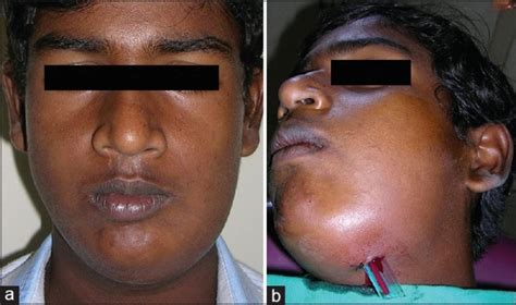 Facial Infections Treatment In Hyderabad