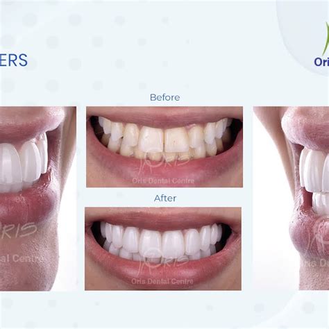 Oris Dental Center Jumeirah Dental Implants Dental Veneers