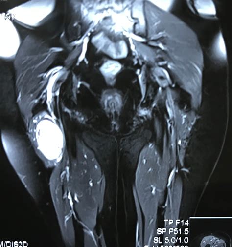 Vietnamese Medic Ultrasound Case 473 Sciatic Nerve Tumor Dr Phan
