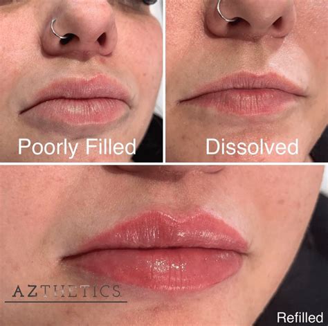 How To Reduce Swelling After Lip Fillers