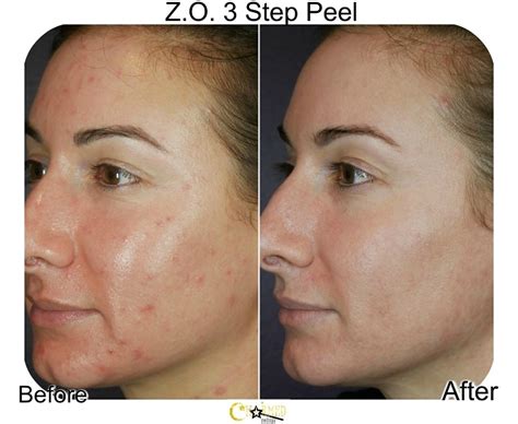 Chemical Peel Season Charmed Medispa