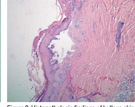 Figure 1 From Bullous Pemphigoid In A Patient With Giant Squamous Cell