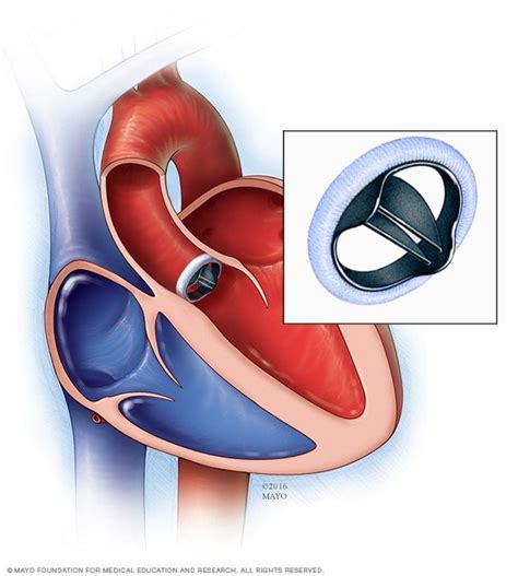 Bicuspid Aortic Valve Overview Mayo Clinic Heart Valves Aortic Valve Replacement Heart