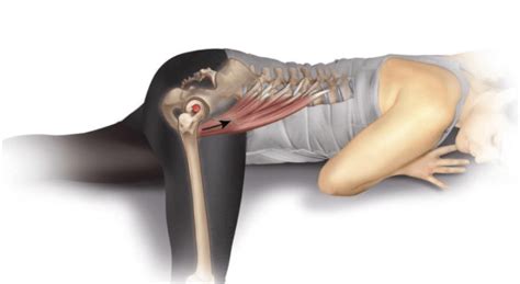 Hip Flexor Tendonitis After Hip Replacement Causes Treatment And Prevention Psoaspro