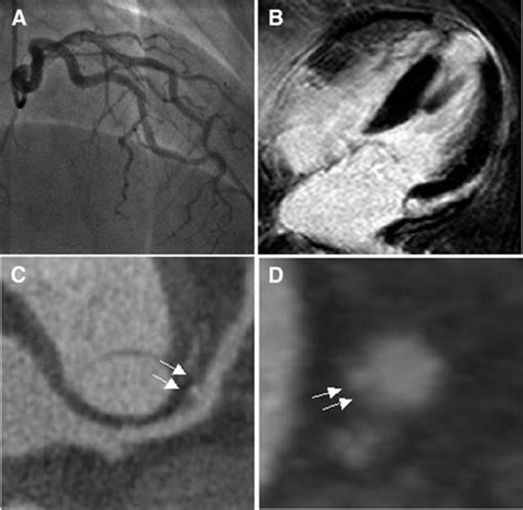 Computed Tomography Coronary Angiography In Patients With Acute