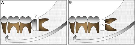 Removal Of Horizontally Impacted Mandibular Third Molars With Large