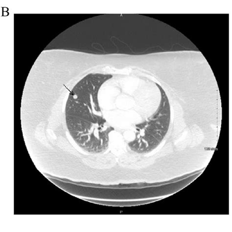 A Ct Chest With Pe Protocol Showing A Non Calcified 14 Mm Pulmonary