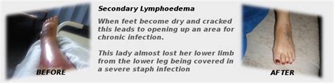 Lipoedema Lymphoedema Academy Of Australia
