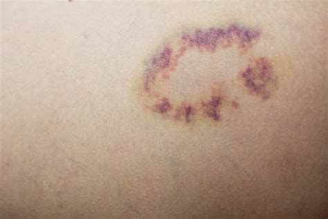 Bruise Purple Hemorrhage Contusion Stock Photos Pictures And Royalty