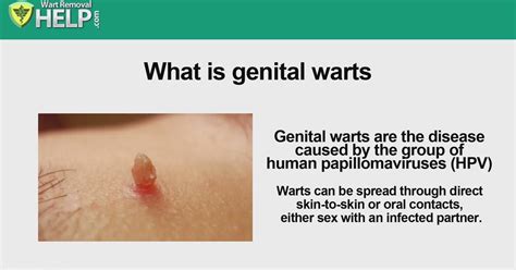 Ppt Genital Herpes Genital Warts Powerpoint Presentation Free My Xxx
