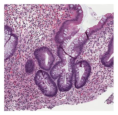 Hande 126x Magnification Showing Changes Of Chronic Active Colitis