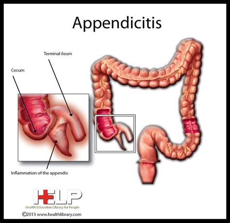 Appendicitis Patient Education Anatomy And Physiology Physiology