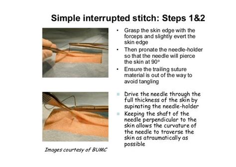 Sutures And Suturing