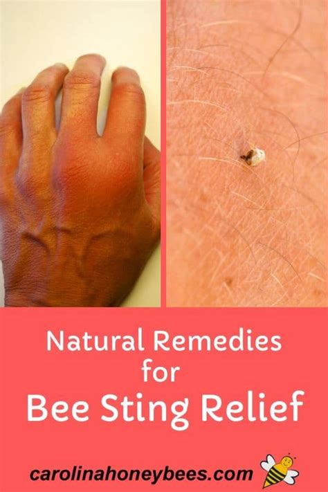 easy home remedies for bee stings carolina honeybees in 2020 remedies for bee stings bee